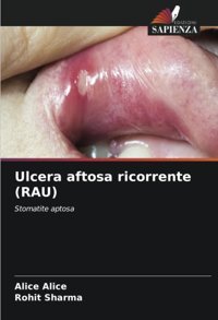 Ulcera Aftosa Ricorrente (Rau): Stomatite Aptosa Alice, Alice Edizioni Sapienza
