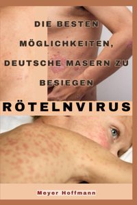 Rötelnvirus: Die Besten Möglichkeiten, Deutsche Masern Zu Besiegen Hoffmann, Meyer Independently Publıshed
