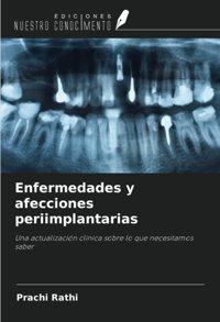 Enfermedades Y Afecciones Periimplantarias: Una Actualizacin Clnica Sobre Lo Que Necesitamos Saber Rathi, Prachi Ediciones Nuestro Conocimiento