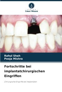 Fortschritte Bei İmplantatchirurgischen Eingriffen: Chirurgische Eingriffe Bei Implantaten Shah, Rahul Verlag Unser Wissen