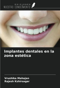Implantes Dentales En La Zona Esttica Mahajan, Vrushika Ediciones Nuestro Conocimiento