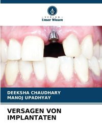 Versagen Von Implantaten: De Chaudhary, Deeksha Verlag Unser Wissen