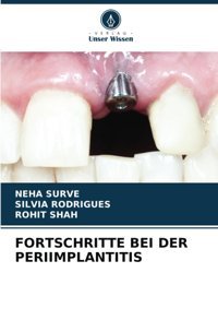 Fortschrıtte Beı Der Perıımplantıtıs Surve, Neha Verlag Unser Wissen