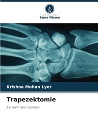 Trapezektomie: Exzision Des Trapezes Lyer, Krishna Mohan Verlag Unser Wissen
