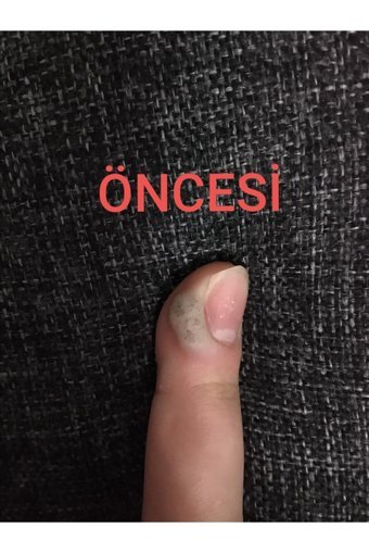 Nasırderm Nasır Ayak Kremi 15 ml