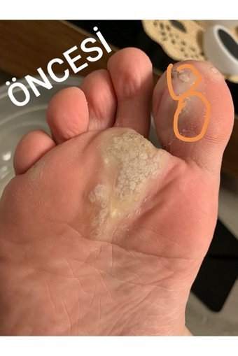 Nasırderm Nasır Ayak Kremi 15 ml