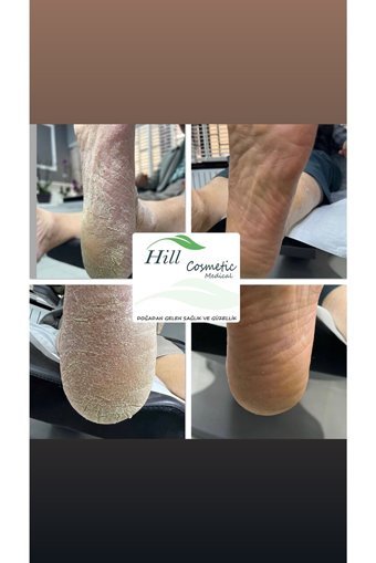 Hillfoot Üreli Bakım Ayak Kremi 100 ml