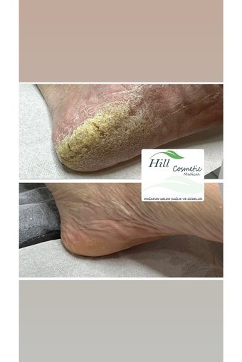Hillfoot Üreli Bakım Ayak Kremi 100 ml