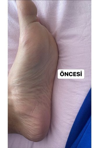Hodaf Exfoliating Ölü Deri-Çatlak Çorap Tipi Ayak Peeling Maskesi 2 Adet
