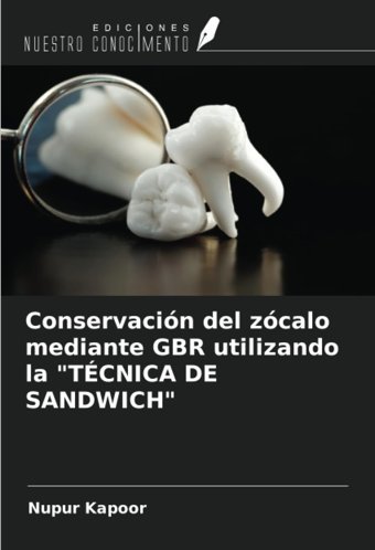 Conservacin Del Zcalo Mediante Gbr Utilizando La Tcnıca De Sandwıch Kapoor, Nupur Ediciones Nuestro Conocimiento