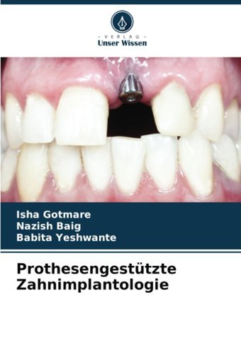 Prothesengestützte Zahnimplantologie Gotmare, Isha Verlag Unser Wissen