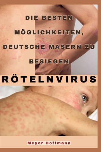 Rötelnvirus: Die Besten Möglichkeiten, Deutsche Masern Zu Besiegen Hoffmann, Meyer Independently Publıshed