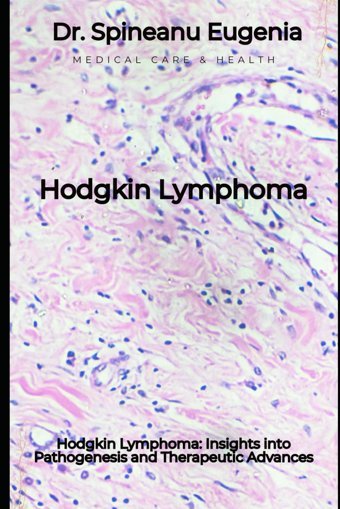 Hodgkin Lymphoma: Insights İnto Pathogenesis And Therapeutic Advances Eugenia, Dr. Spineanu Independently Publıshed