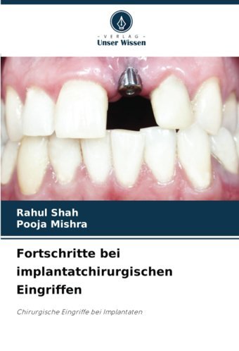 Fortschritte Bei İmplantatchirurgischen Eingriffen: Chirurgische Eingriffe Bei Implantaten Shah, Rahul Verlag Unser Wissen