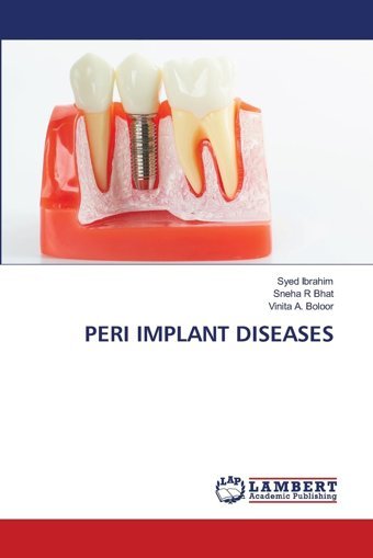 Perı Implant Dıseases: De Ibrahim, Syed Lap Lambert Academic Publishing