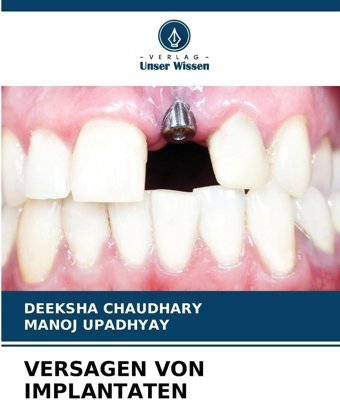 Versagen Von Implantaten: De Chaudhary, Deeksha Verlag Unser Wissen