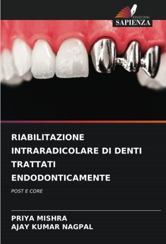 Rıabılıtazıone Intraradıcolare Dı Dentı Trattatı Endodontıcamente: Post E Core Mıshra, Prıya Edizioni Sapienza