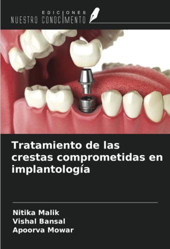Tratamiento De Las Crestas Comprometidas En İmplantologa Malik, Nitika Ediciones Nuestro Conocimiento