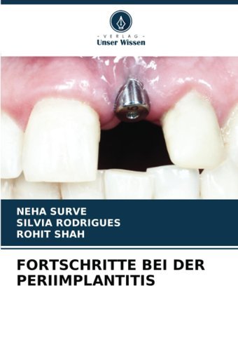 Fortschrıtte Beı Der Perıımplantıtıs Surve, Neha Verlag Unser Wissen
