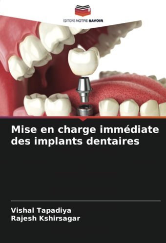 Mise En Charge İmmdiate Des İmplants Dentaires Tapadiya, Vishal Editions Notre Savoir