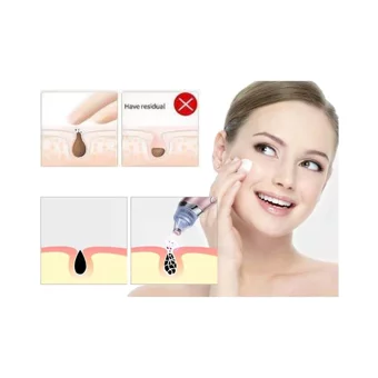Xolo 4 İn 1 Tüm Ciltler İçin 4 Başlıklı Pilli Vakumlu Yüz Temizleme Cihazı Rose