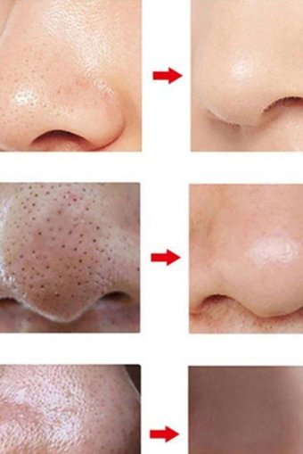 Utelips İl119b Şarjlı Vakumlu Siyah Nokta Temizleme Aleti Pembe