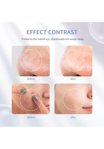 Cosbeauty Ultrasonik Ipx5 Şarjlı Vakumlu Siyah Nokta Temizleme Aleti Kırmızı